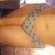 Front view 1 year,4 months post op
