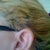 Mar 19 2011 left ear 11 months after surgery you can clearly see I do not have 5 inch scars down my face & I never did