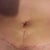 3 weeks post op close up