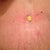 Post Op 15 - Belly Button with ear plug - LOL!