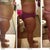 You can see in the day 24 po pic that my lower abdomen looks a lot flatter, but the upper abdomen looks larger than it did in my last pic. The swelling seems to be concentrated there.
