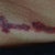 right after 3rd treatment
