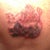 3rd treatment day 2