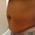 Pre- Surgery pic of my fat rolls