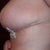Post op week 7.  The skin at the end of the incision should smooth out over time.