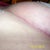 Post op week 7.  The scar--does't look to bad.