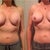 8 - 10 Weeks Post-Op