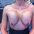 3 Days Post-Op