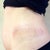 Side Bruises!  Will post more pictures when I see results.