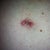 hypertrophic BB scar- being revised tomorrow!!