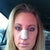 Day five. Out and about. Was able to put on makeup very gently. Swelling is down a lot, still bruised a little.