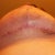 2weeks post-op, underside of right breast