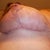 2weeks post-op, underside of left breast
