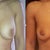 comparison before and 2 weeks after explant