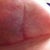 Left Tzone Week 6  A Tiny scab is there but its so small I can hardly tell its there.  I suspect it is just a stitch working its way out or dissolving.