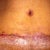 Pic of Scarr and BB at two weeks post op (You can see in the center the two areas that split. That is where I am draining from. The area to the left as you are looking at the pic was where the drain was) BB is doing way better.