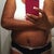 PO Day 18....2 1/2 weeks and the swelling is starting to subside.