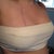 one day post op