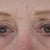 Before surgery mudflap eyelids