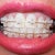 11-12 week follow-up visit.  Lot's of tooth spacing.  2nd Ortho visit.