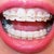 11-12 week follow-up visit.  Lot's of tooth spacing.  2nd Ortho visit.
