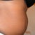 side view before procedure