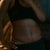 Wk 6- Post op TT