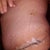 7 days post op