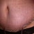 7 days post op still swollen