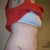 Day 26 Post Op