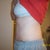 Day 26 Post Op