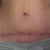 Scar at 46 days P.O.  Roughly 6.5 weeks.  Doesn't look quite as good as a lot of the others on here, but that's just how I heal, lol.