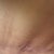 Scar @ 6.5 weeks - this is my bad side