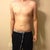 One day after Smart lipo.