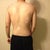 One day after Smart lipo.