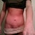 6 weeks post op front view