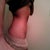6 weeks post op left side
