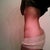 6 weeks post op right side