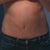 Two weeks after.  Same jeans as before pictures.  Small lumps and bumps are visible below belly button as well as small bruises from overzealous massaging.