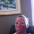 Day 1, after the procedure.  (There is PRP on the left side of my face.)