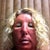 Day 2 in the afternoon.  I had a LOT of swelling that day, to the point where I could not see well enough to drive.