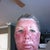 Day 3. The swelling is migrating south, and I am starting to "bronze."