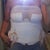 MM Day 6 Post OP. I am hunched over so not the best pic of my breast. :) So happy with them though!