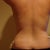 two week post op. 10-26-2010