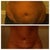Before - 5 months post op