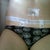 After 1st dressing change - Day 6