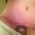 scar 2 months po