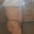 19 days post op side