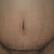 19 days post op belly button close up