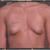 Before implants